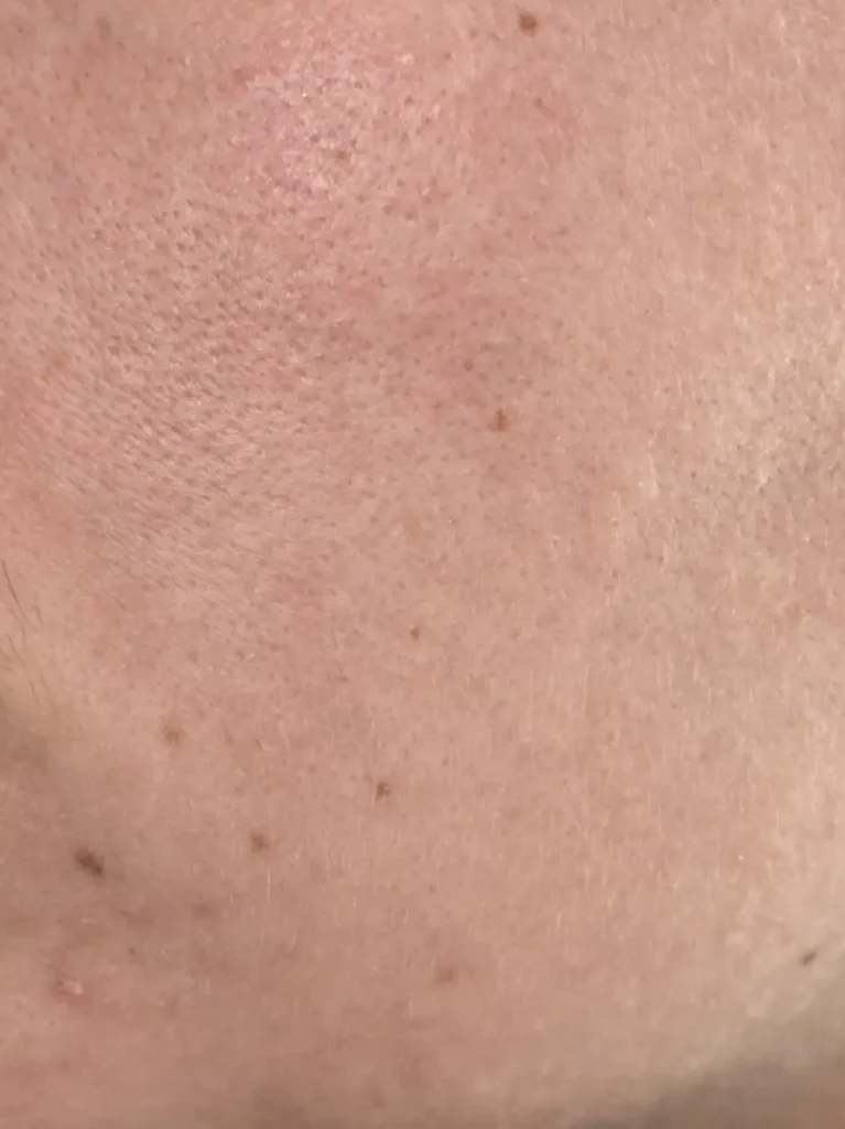 After eight weeks test omnilux led mask 1
