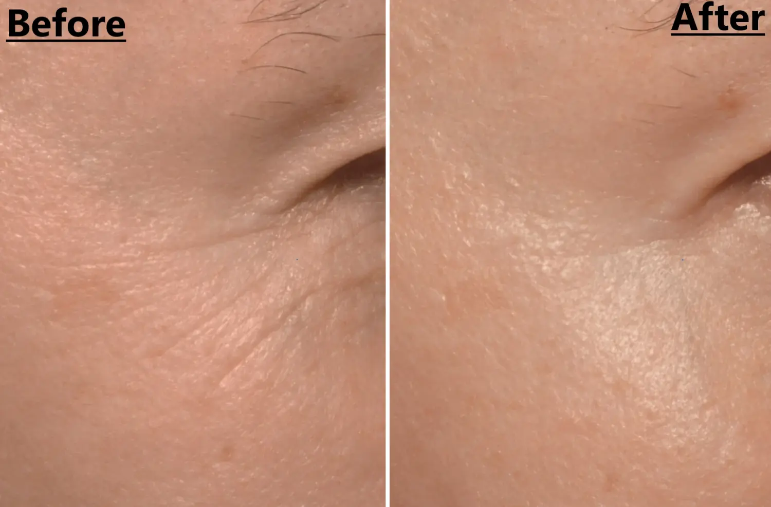 Before after facial wrinkles goose legs led mask nooance elite x600