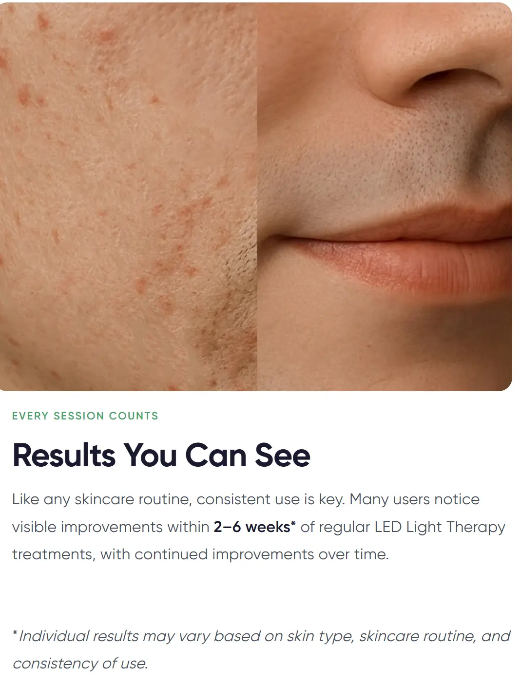 Nanoleaf before and after panel showing an acne-textured cheek on the left and a smooth nose and mouth on the right, with a 2 to 6 weeks claim underneath