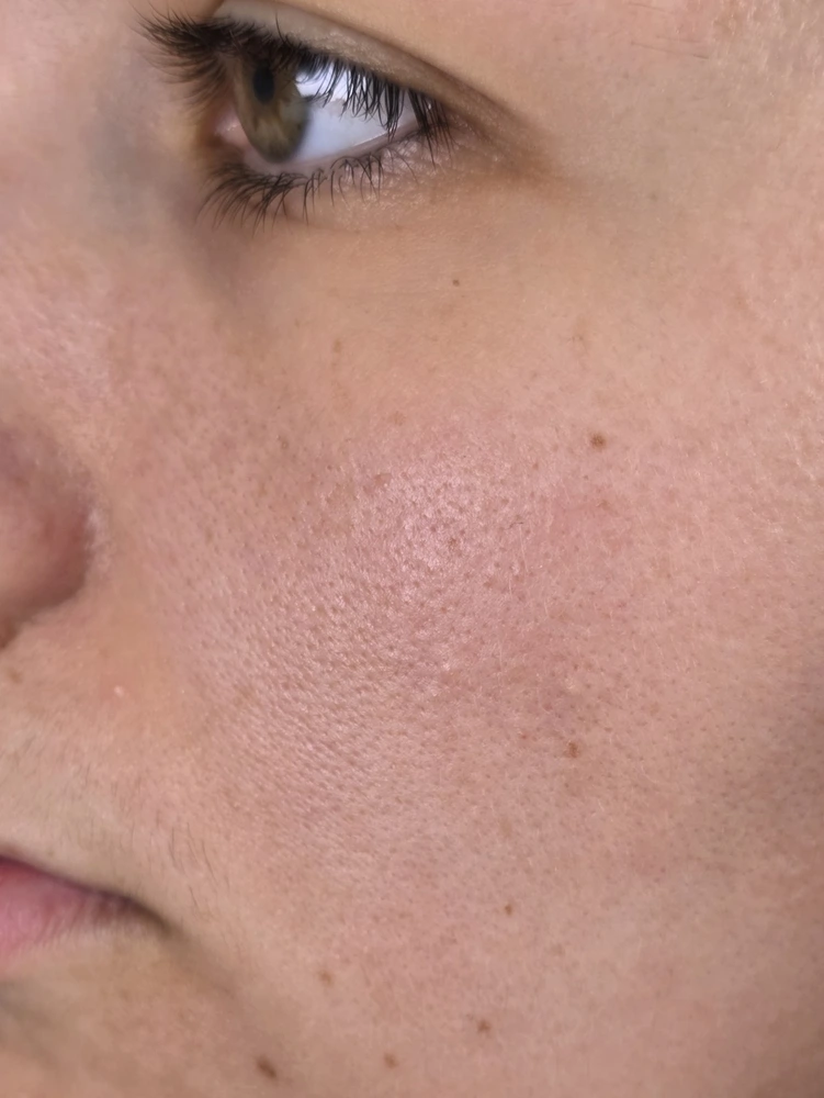 Emilie's face at week 12 of her Elite X600 test, same lighting