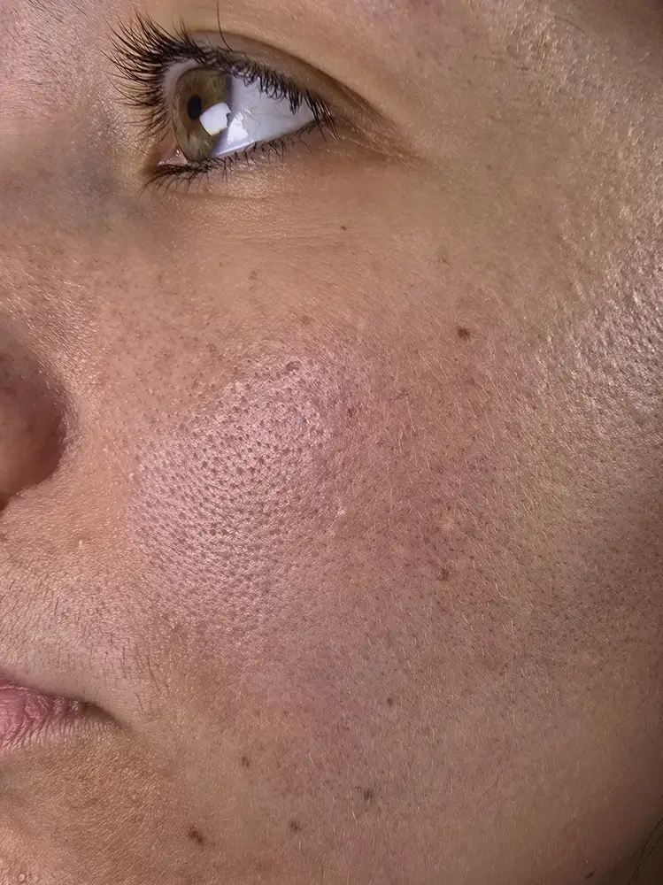 Emilie's face at week 1 of her Elite X600 test, no makeup