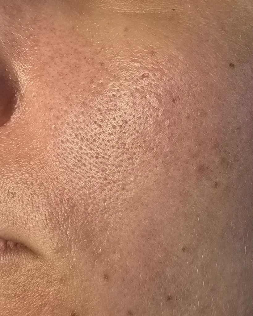 Before after result after foreo led mask
