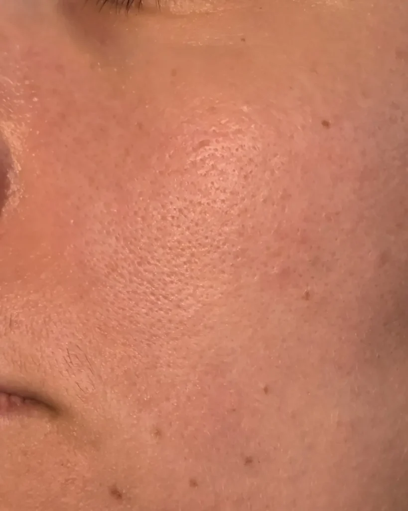 Before after result before foreo led mask