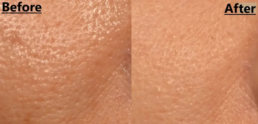 Before after skin texture pores nooance elite x600 led mask