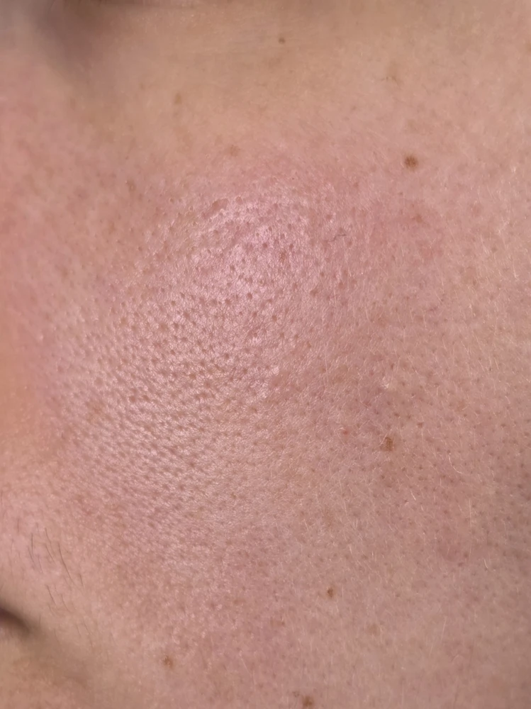 Close-up of Emilie's nose and cheek at week 12 of the Elite X600 test